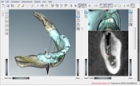 Computertomographisch basierte 3D-Planung von Implantationen