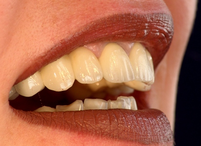 full-ceramic crowns and bridges