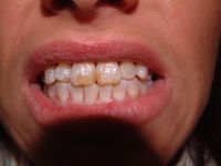 Veneers